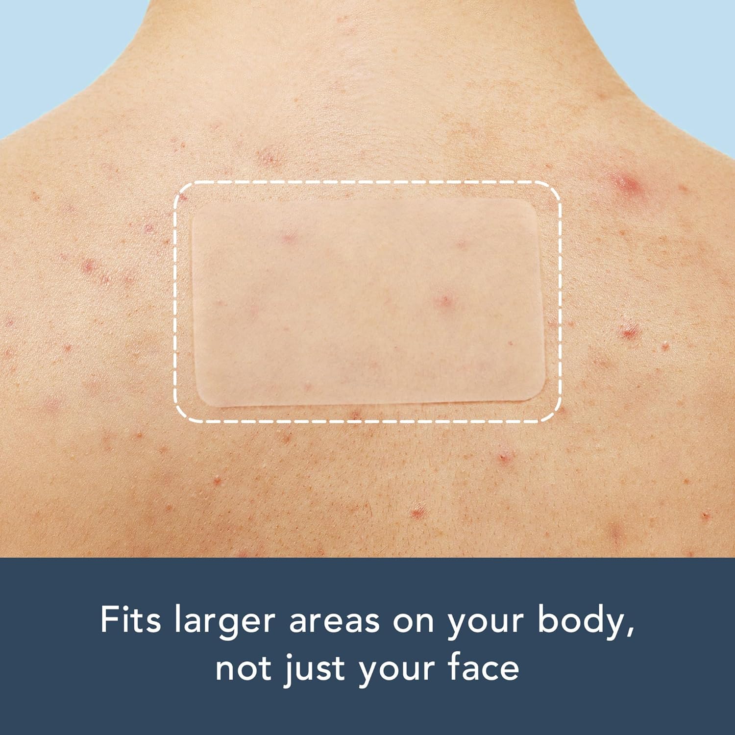 15 large-sized, long acne patc - Anti-Aging Face Cream review and price